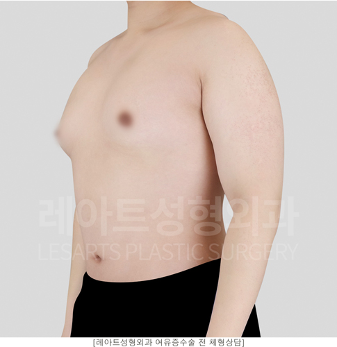 post_23_gynecomastia -before-Medical-photo