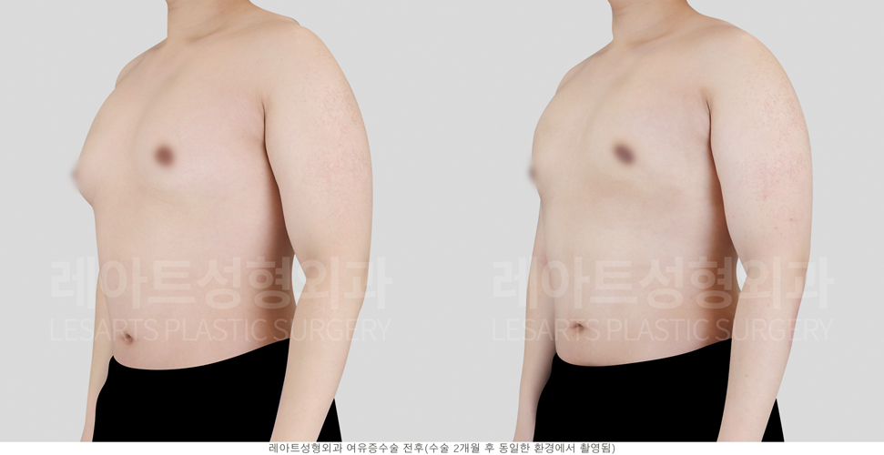 post_23_gynecomastia -before-Medical-photo3