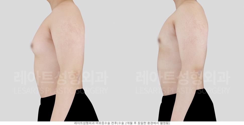 post_23_gynecomastia -before-Medical-photo4