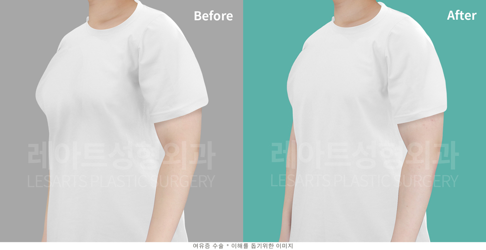 post_23_gynecomastia -bna