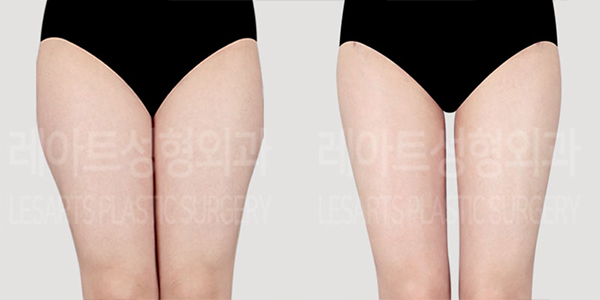 post_71_01_thigh_liposuction_thumbnail