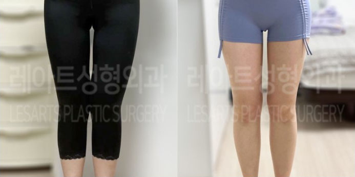 post_71_02_thigh_liposuction_02