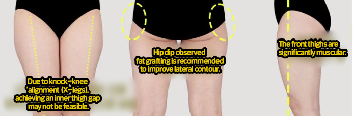 post_71_02_thigh_liposuction_04