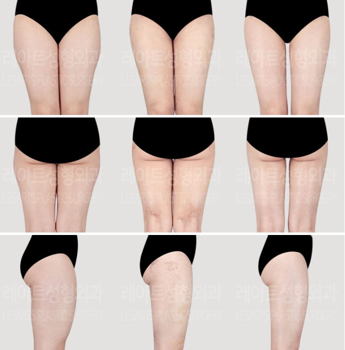 post_71_02_thigh_liposuction_06