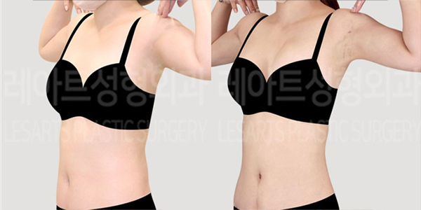 post_72_01_abdominal_liposuction_arm_liposuction_thumbnail