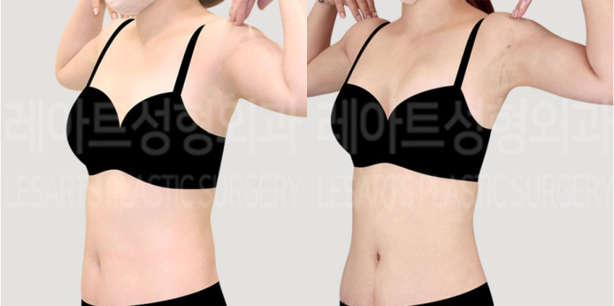 post_72_02_abdominal_liposuction_arm_liposuction_01