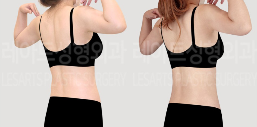 post_72_02_abdominal_liposuction_arm_liposuction_02