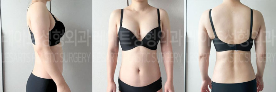 post_72_02_abdominal_liposuction_arm_liposuction_03