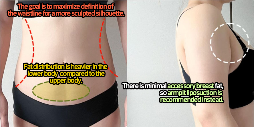 post_72_02_abdominal_liposuction_arm_liposuction_04