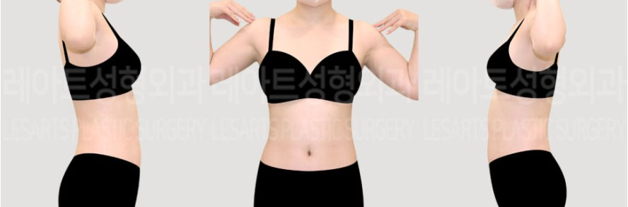 post_72_02_abdominal_liposuction_arm_liposuction_06