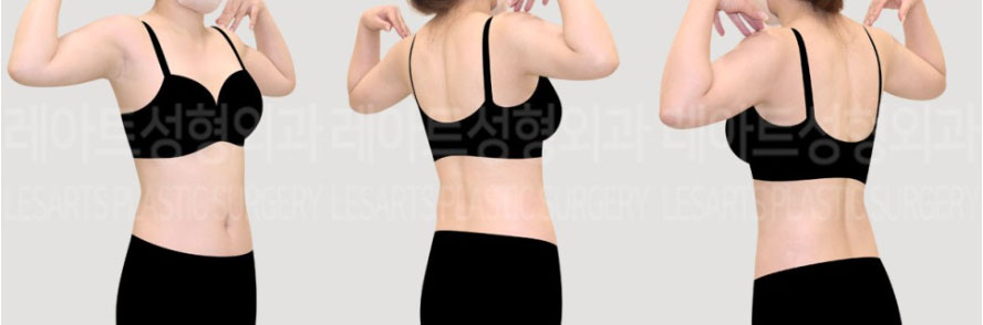 post_72_02_abdominal_liposuction_arm_liposuction_07