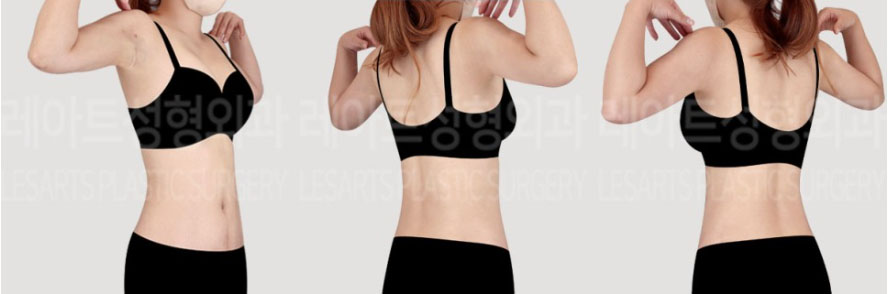 post_72_02_abdominal_liposuction_arm_liposuction_08