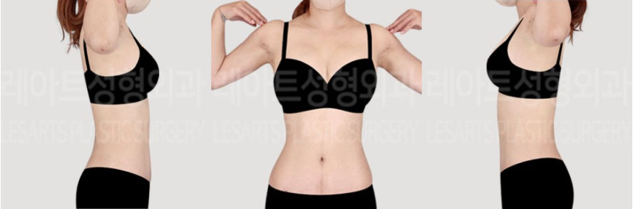 post_72_02_abdominal_liposuction_arm_liposuction_6