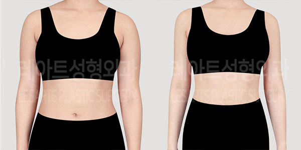 post_73_01_arm_liposuction_thumbnail