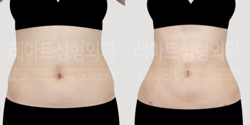 abdominal liposuction_body_liposuction_thumbnail