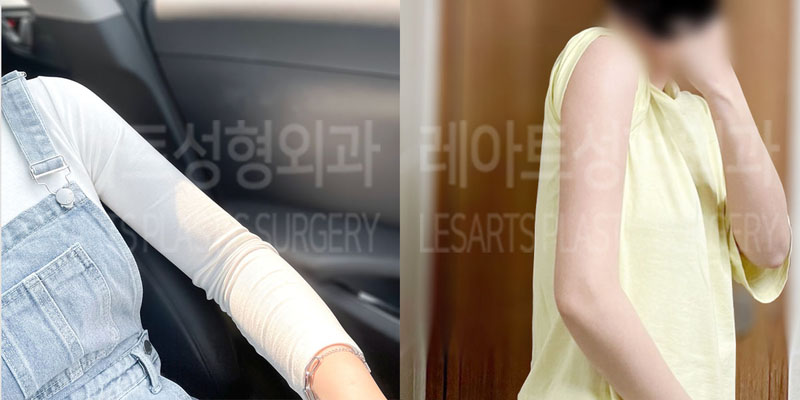 post_73_02_arm_liposuction_02