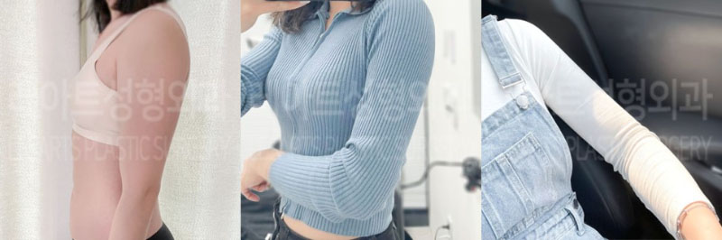 post_73_02_arm_liposuction_03