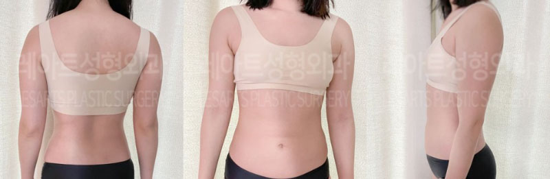 post_73_02_arm_liposuction_04