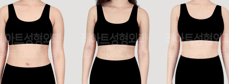post_73_02_arm_liposuction_05