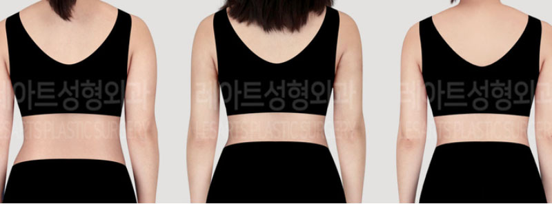 post_73_02_arm_liposuction_06
