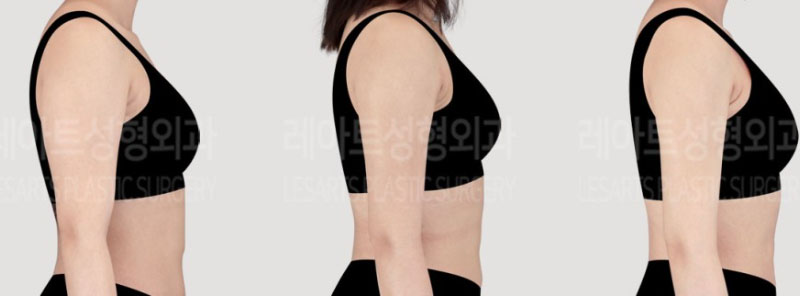 post_73_02_arm_liposuction_07