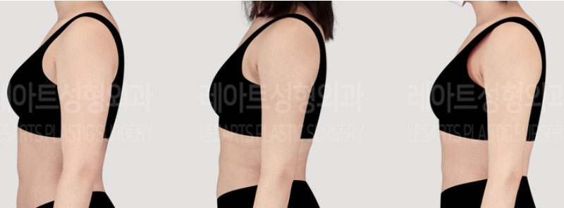 post_73_02_arm_liposuction_08