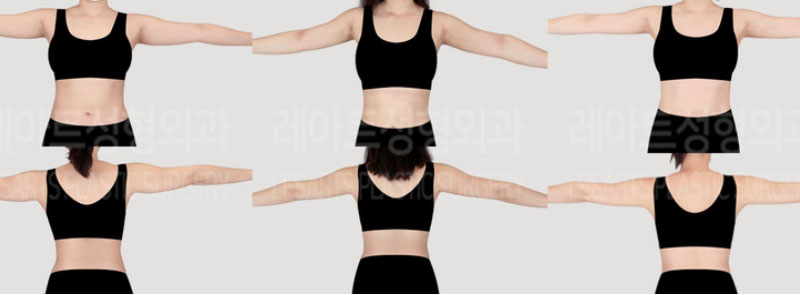 post_73_02_arm_liposuction_08