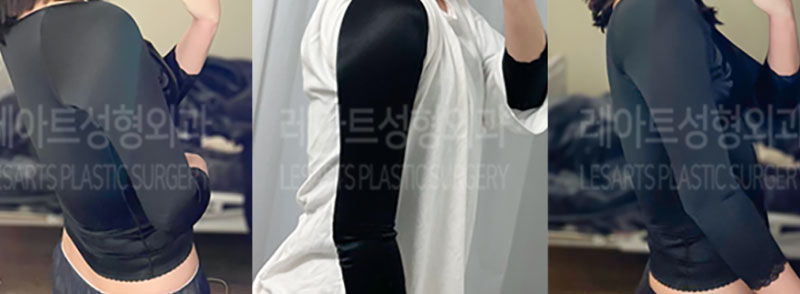 post_73_02_arm_liposuction_10
