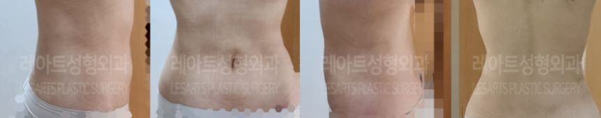 post_73_02_body_liposuction_01