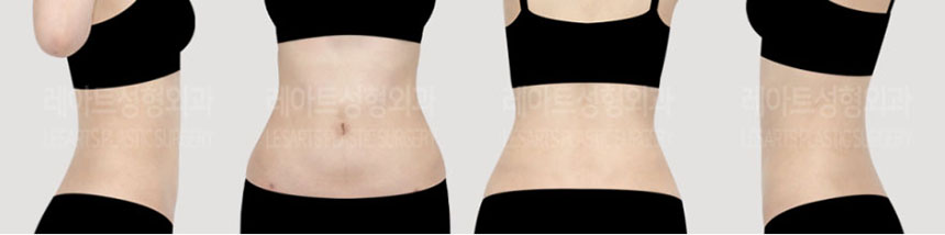 post_73_02_body_liposuction_02
