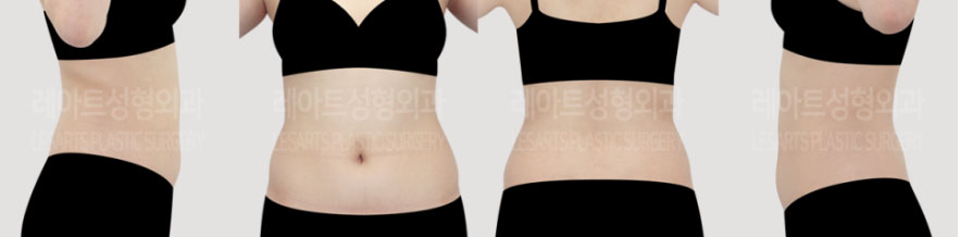 post_73_02_body_liposuction_03