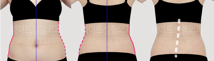 post_73_02_body_liposuction_04
