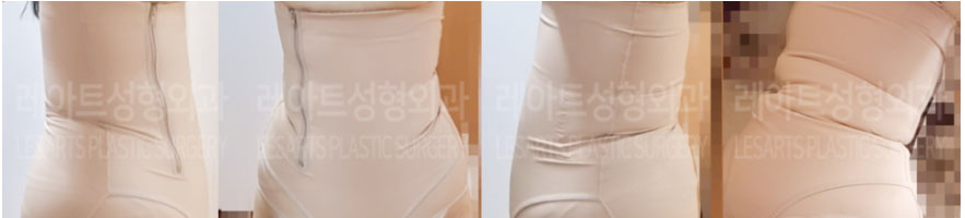 post_73_02_body_liposuction_05