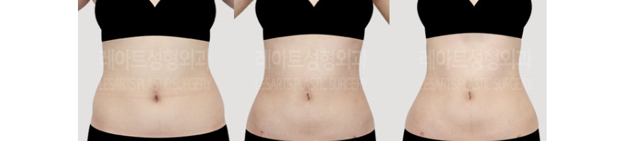 post_73_02_body_liposuction_06
