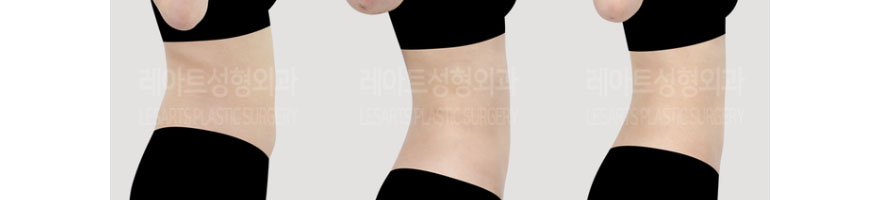 post_73_02_body_liposuction_08