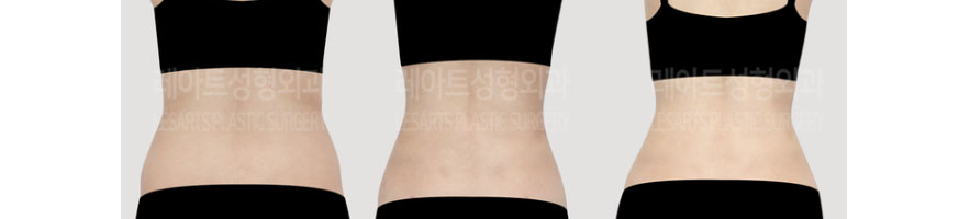 post_73_02_body_liposuction_7