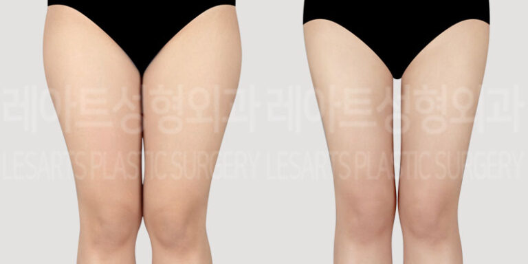 post_75_01_thigh_liposuction_thumbnail