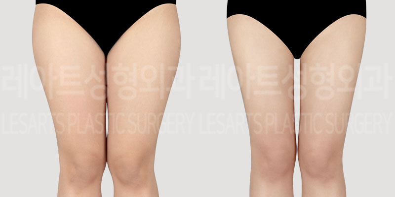 post_75_01_thigh_liposuction_thumbnail