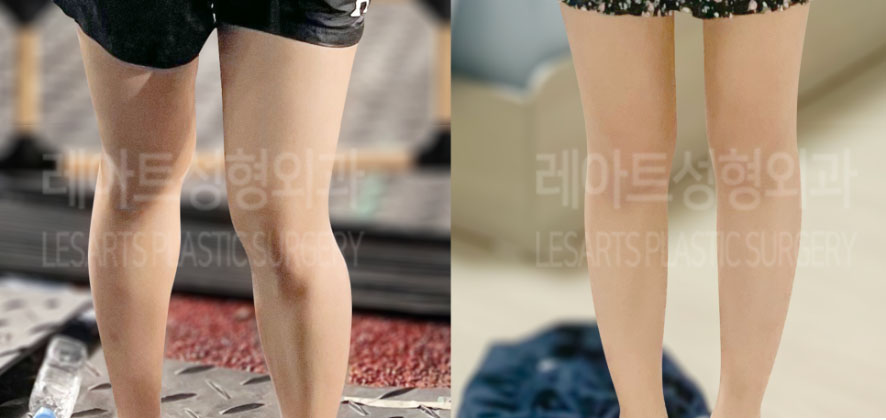 post_75_02_thigh_liposuction_02