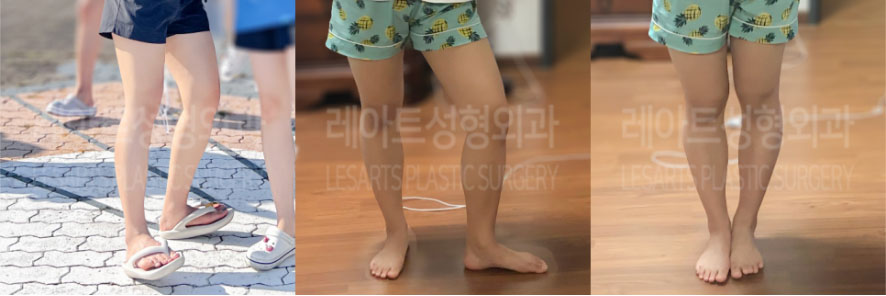 post_75_02_thigh_liposuction_04