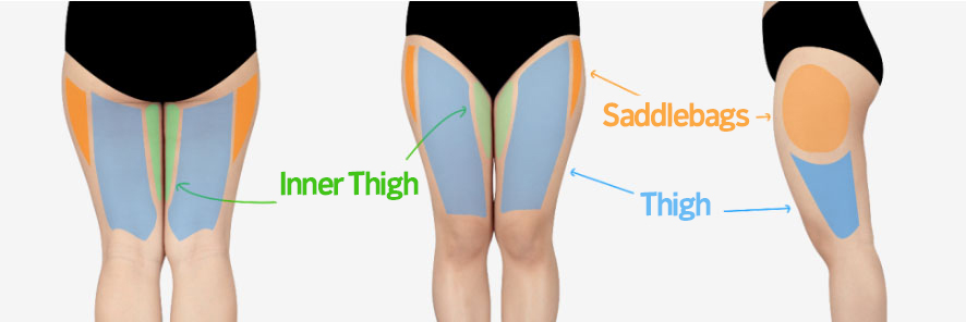post_75_02_thigh_liposuction_05
