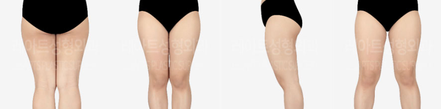 post_75_02_thigh_liposuction_06