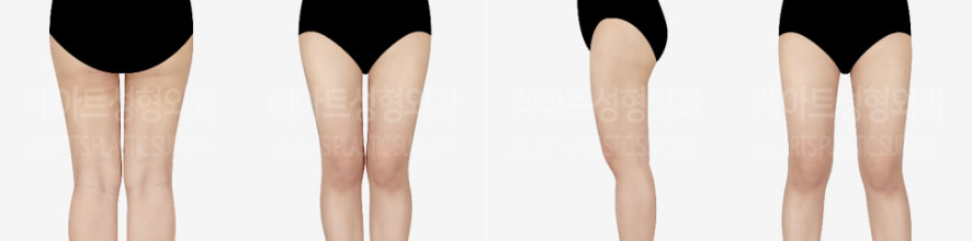 post_75_02_thigh_liposuction_08