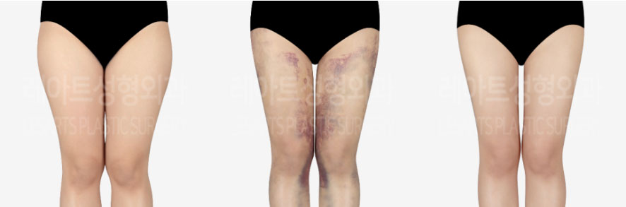 post_75_02_thigh_liposuction_09
