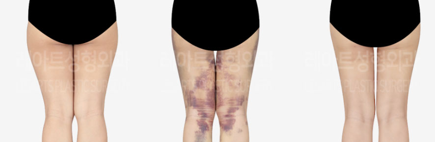 post_75_02_thigh_liposuction_10