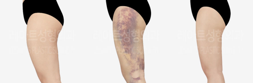 post_75_02_thigh_liposuction_11