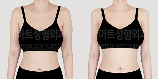 post_76_01_arm_liposuction_thumbnail