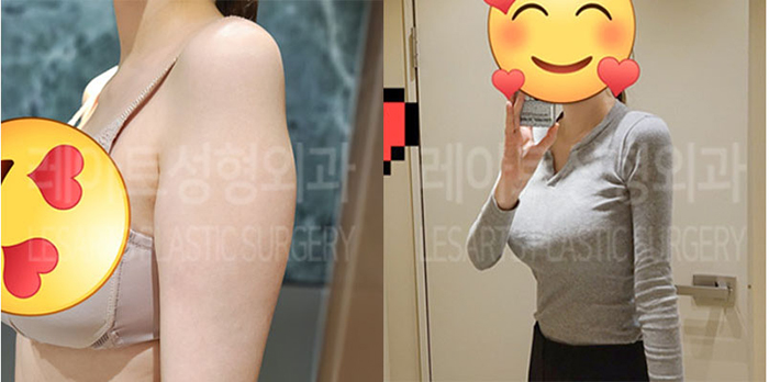 post_76_02_arm_liposuction_01
