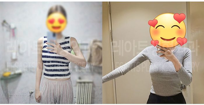post_76_02_arm_liposuction_02