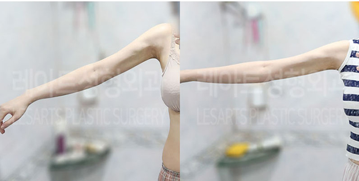post_76_02_arm_liposuction_03